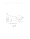 DIGITAL DENTAL MODELING diagram and image