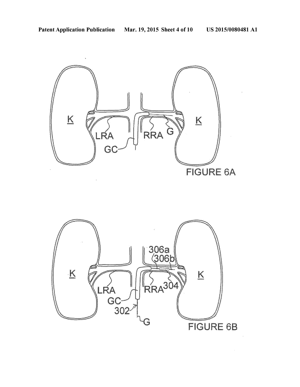 Methods for renal neuromodulation - diagram, schematic, and image 05