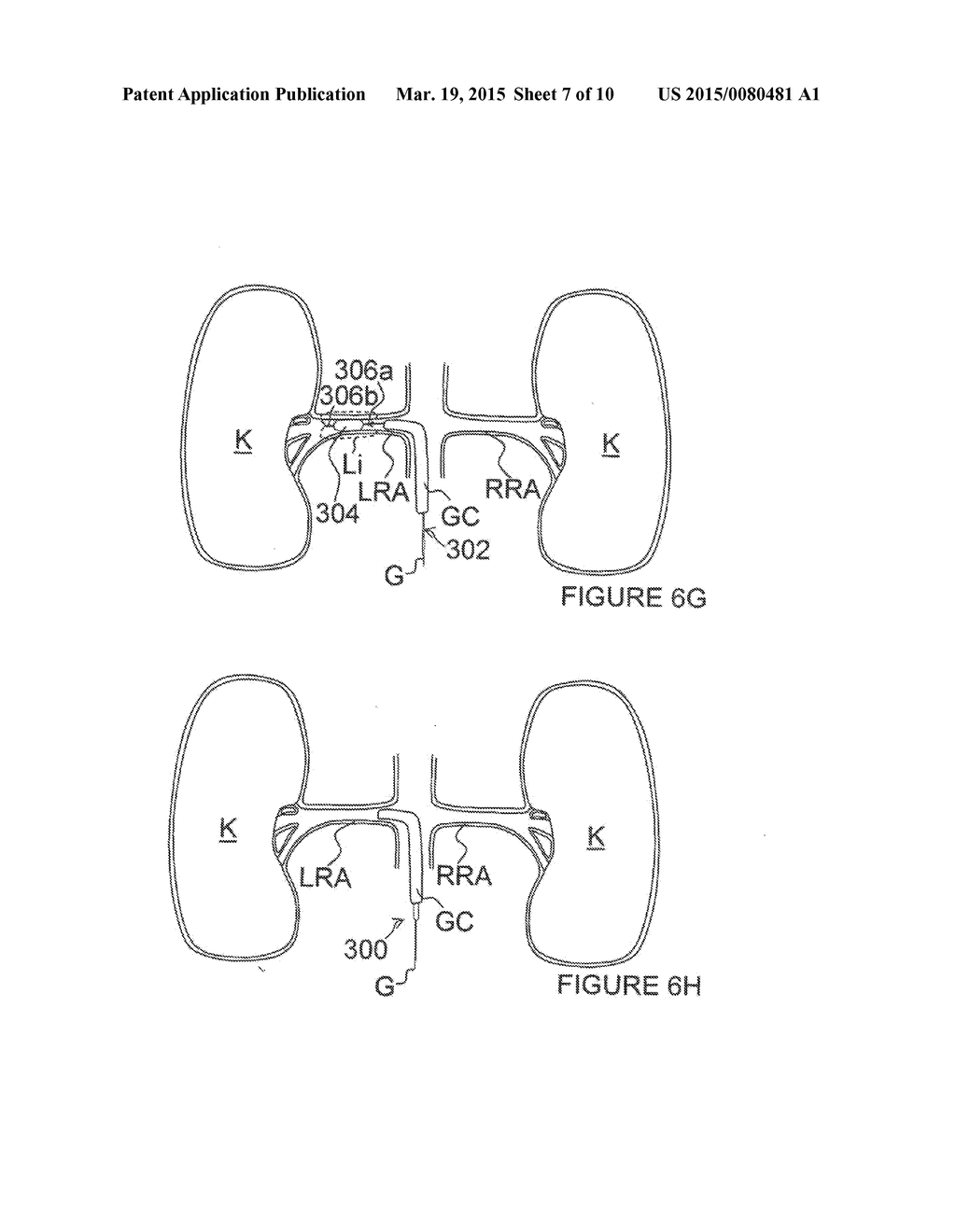 Methods for renal neuromodulation - diagram, schematic, and image 08