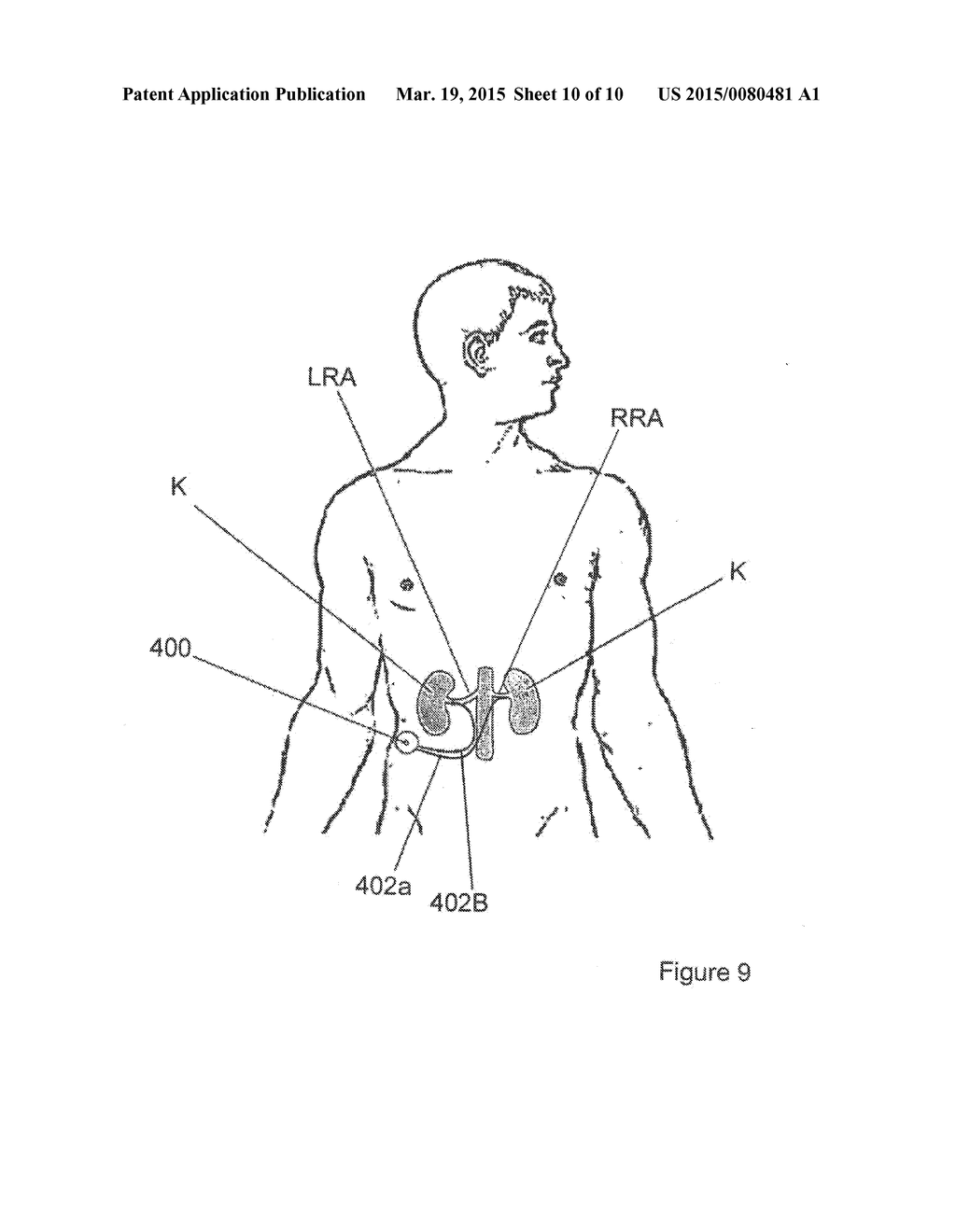 Methods for renal neuromodulation - diagram, schematic, and image 11