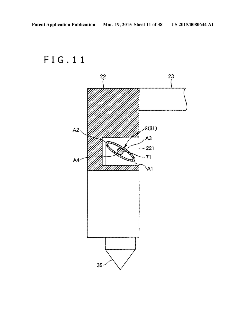 IMPLANT AND METHOD OF PLACING IMPLANT INDWELLING - diagram, schematic, and image 12