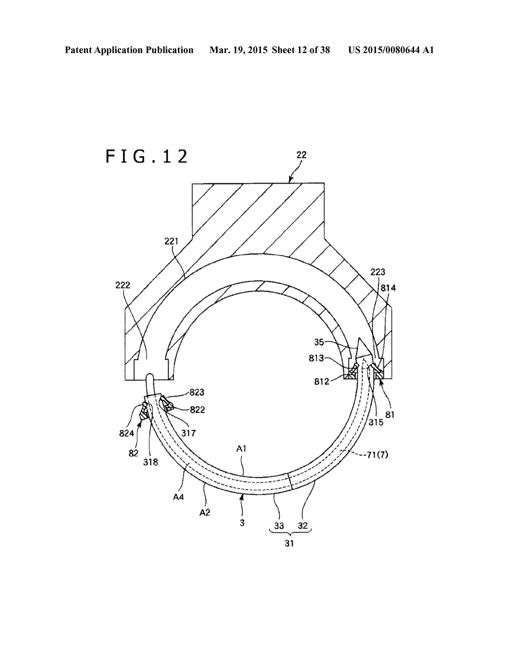 IMPLANT AND METHOD OF PLACING IMPLANT INDWELLING - diagram, schematic, and image 13