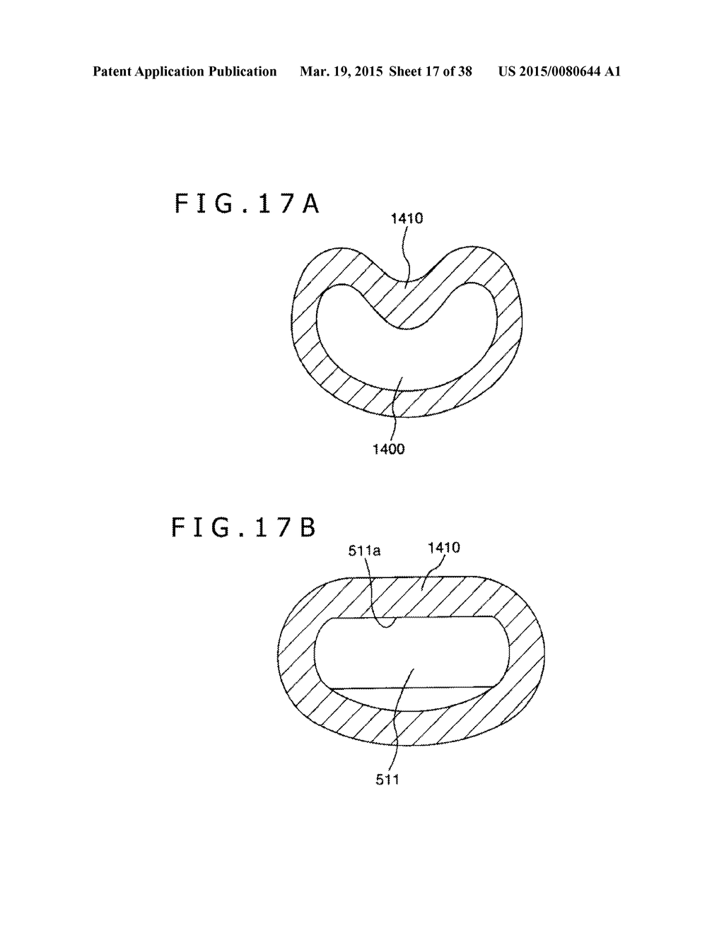 IMPLANT AND METHOD OF PLACING IMPLANT INDWELLING - diagram, schematic, and image 18