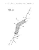 IMPLANT AND METHOD OF PLACING IMPLANT INDWELLING diagram and image