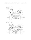 IMPLANT AND METHOD OF PLACING IMPLANT INDWELLING diagram and image