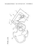 IMPLANT AND METHOD OF PLACING IMPLANT INDWELLING diagram and image