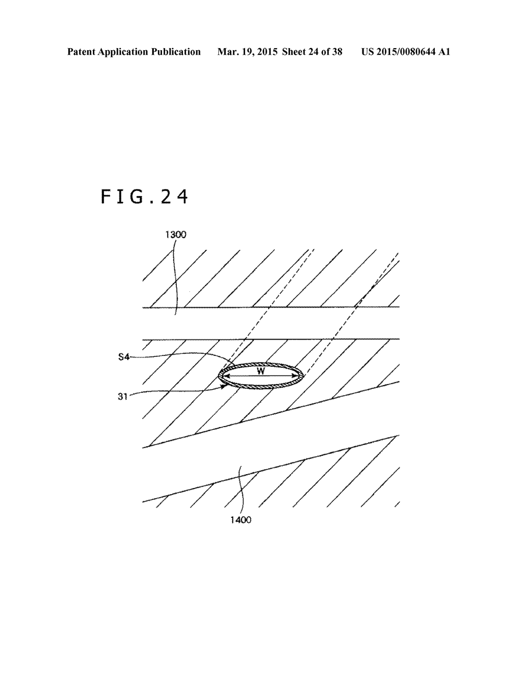 IMPLANT AND METHOD OF PLACING IMPLANT INDWELLING - diagram, schematic, and image 25