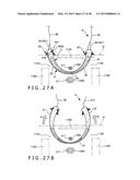 IMPLANT AND METHOD OF PLACING IMPLANT INDWELLING diagram and image