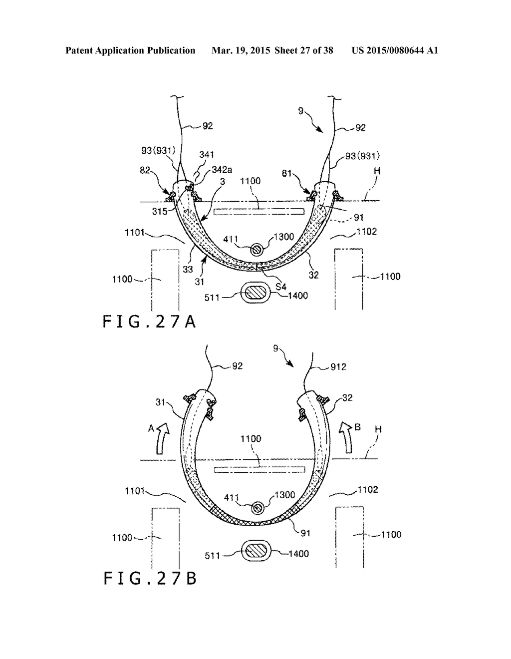 IMPLANT AND METHOD OF PLACING IMPLANT INDWELLING - diagram, schematic, and image 28