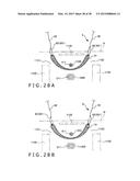 IMPLANT AND METHOD OF PLACING IMPLANT INDWELLING diagram and image