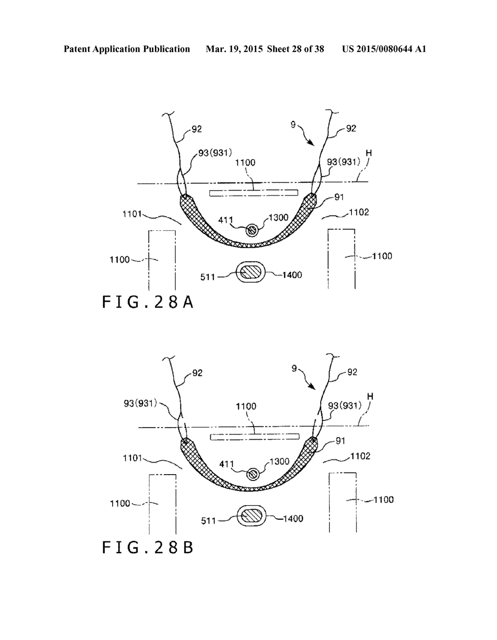 IMPLANT AND METHOD OF PLACING IMPLANT INDWELLING - diagram, schematic, and image 29