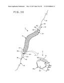 IMPLANT AND METHOD OF PLACING IMPLANT INDWELLING diagram and image