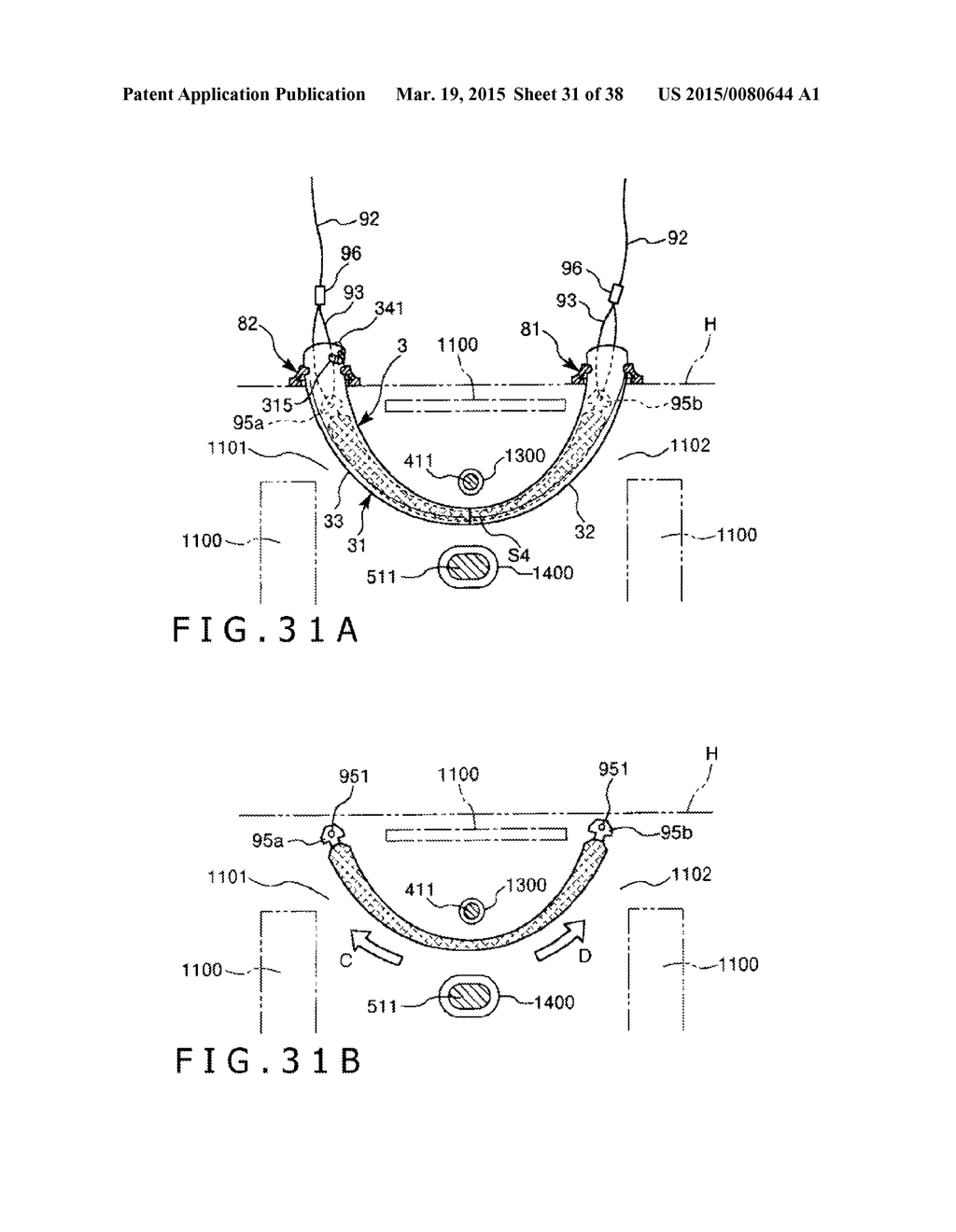 IMPLANT AND METHOD OF PLACING IMPLANT INDWELLING - diagram, schematic, and image 32