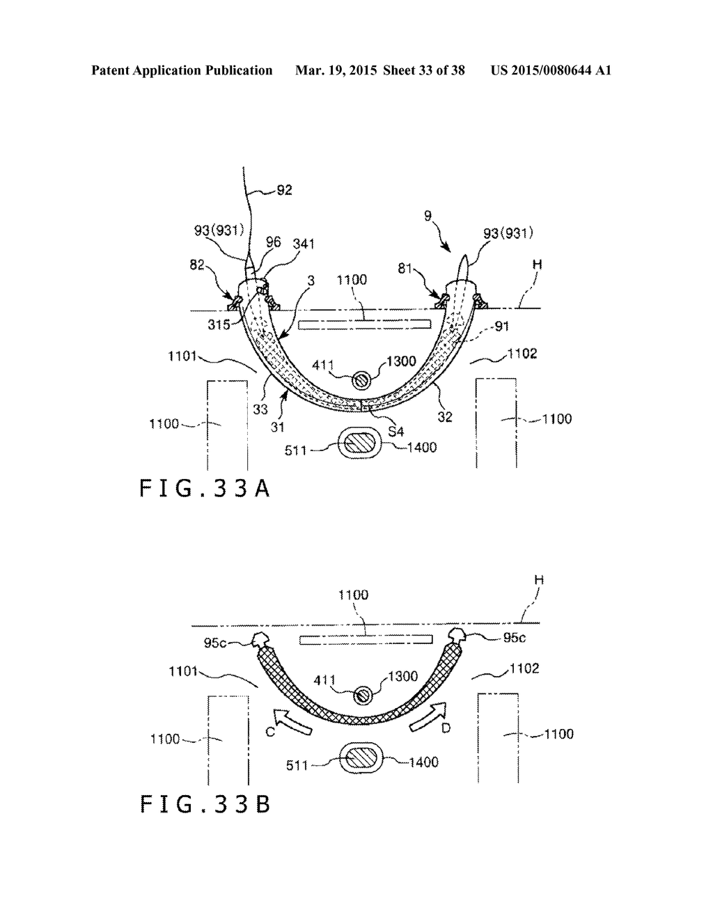 IMPLANT AND METHOD OF PLACING IMPLANT INDWELLING - diagram, schematic, and image 34