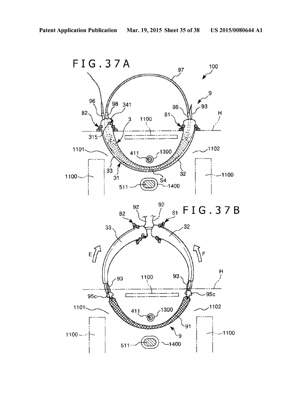 IMPLANT AND METHOD OF PLACING IMPLANT INDWELLING - diagram, schematic, and image 36