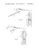 Systems and Methods for Introducing and Applying a Bandage Structure     Within a Body Lumen or Hollow Body Organ diagram and image