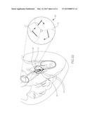 INTRACORPOREAL IMAGING AID (IMA) diagram and image