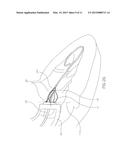 INTRACORPOREAL IMAGING AID (IMA) diagram and image