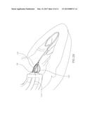 INTRACORPOREAL IMAGING AID (IMA) diagram and image