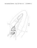 INTRACORPOREAL IMAGING AID (IMA) diagram and image