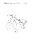 Medical device system including guide rod illumination diagram and image