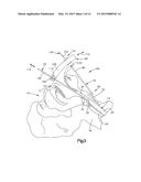 Medical device system including guide rod illumination diagram and image