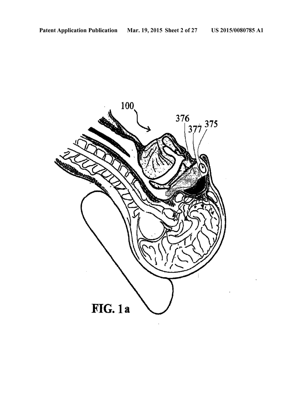 ALZHEIMER'S DISEASE TREATMENT WITH MULTIPLE THERAPEUTIC AGENTS DELIVERED     TO THE OLFACTORY REGION THROUGH A SPECIAL DELIVERY CATHETER AND     IONTOPHORESIS - diagram, schematic, and image 03