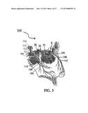 ALZHEIMER S DISEASE TREATMENT WITH MULTIPLE THERAPEUTIC AGENTS DELIVERED     TO THE OLFACTORY REGION THROUGH A SPECIAL DELIVERY CATHETER AND     IONTOPHORESIS diagram and image