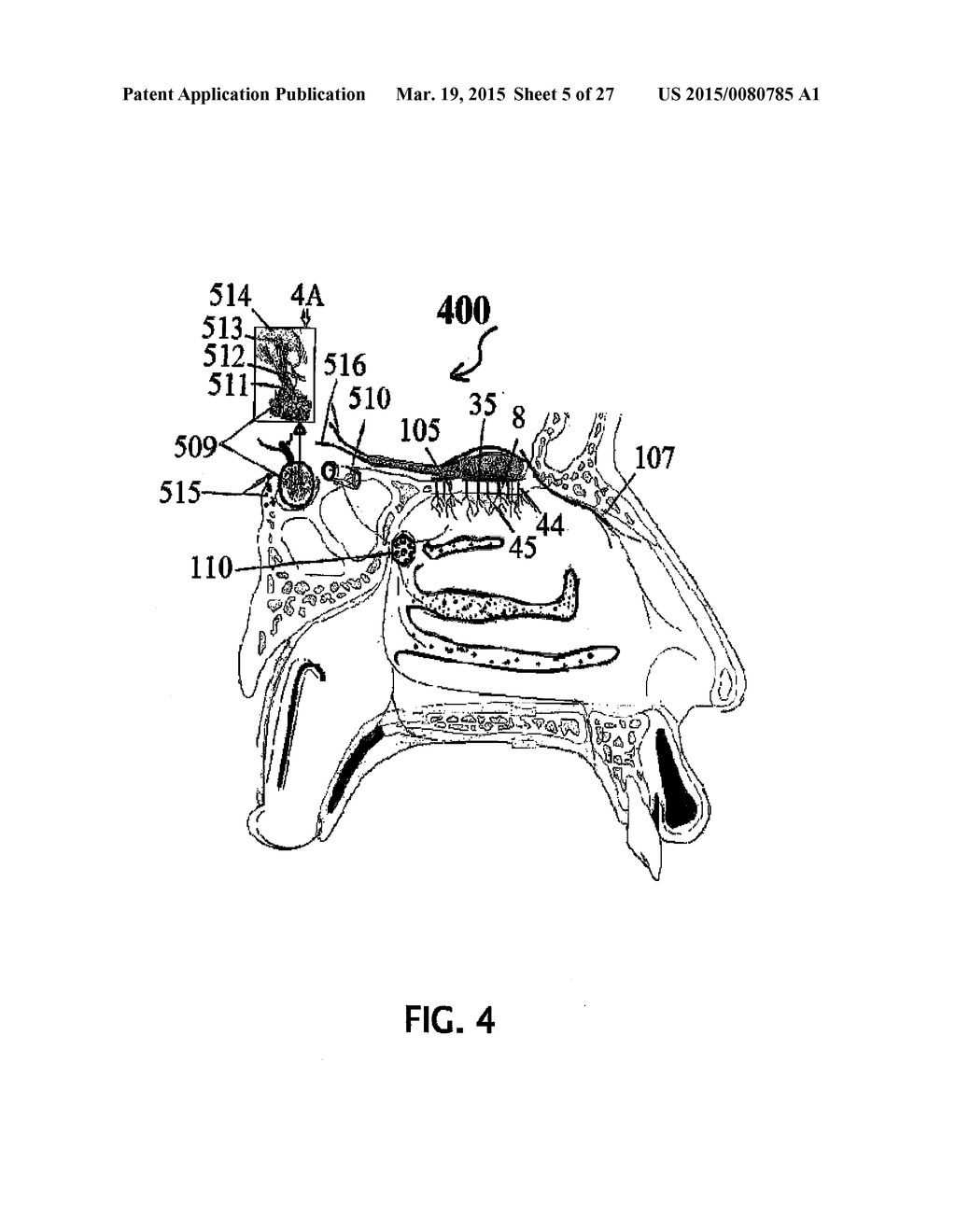 ALZHEIMER'S DISEASE TREATMENT WITH MULTIPLE THERAPEUTIC AGENTS DELIVERED     TO THE OLFACTORY REGION THROUGH A SPECIAL DELIVERY CATHETER AND     IONTOPHORESIS - diagram, schematic, and image 06