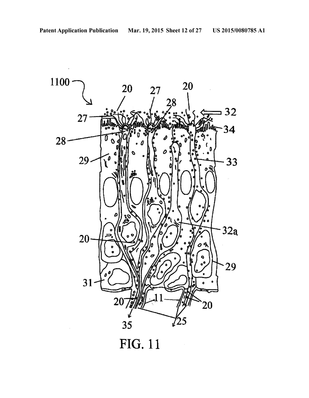 ALZHEIMER'S DISEASE TREATMENT WITH MULTIPLE THERAPEUTIC AGENTS DELIVERED     TO THE OLFACTORY REGION THROUGH A SPECIAL DELIVERY CATHETER AND     IONTOPHORESIS - diagram, schematic, and image 13