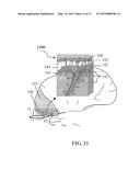 ALZHEIMER S DISEASE TREATMENT WITH MULTIPLE THERAPEUTIC AGENTS DELIVERED     TO THE OLFACTORY REGION THROUGH A SPECIAL DELIVERY CATHETER AND     IONTOPHORESIS diagram and image