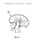 ALZHEIMER S DISEASE TREATMENT WITH MULTIPLE THERAPEUTIC AGENTS DELIVERED     TO THE OLFACTORY REGION THROUGH A SPECIAL DELIVERY CATHETER AND     IONTOPHORESIS diagram and image