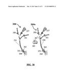 ALZHEIMER S DISEASE TREATMENT WITH MULTIPLE THERAPEUTIC AGENTS DELIVERED     TO THE OLFACTORY REGION THROUGH A SPECIAL DELIVERY CATHETER AND     IONTOPHORESIS diagram and image