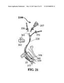 ALZHEIMER S DISEASE TREATMENT WITH MULTIPLE THERAPEUTIC AGENTS DELIVERED     TO THE OLFACTORY REGION THROUGH A SPECIAL DELIVERY CATHETER AND     IONTOPHORESIS diagram and image