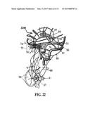 ALZHEIMER S DISEASE TREATMENT WITH MULTIPLE THERAPEUTIC AGENTS DELIVERED     TO THE OLFACTORY REGION THROUGH A SPECIAL DELIVERY CATHETER AND     IONTOPHORESIS diagram and image