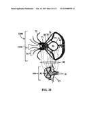 ALZHEIMER S DISEASE TREATMENT WITH MULTIPLE THERAPEUTIC AGENTS DELIVERED     TO THE OLFACTORY REGION THROUGH A SPECIAL DELIVERY CATHETER AND     IONTOPHORESIS diagram and image