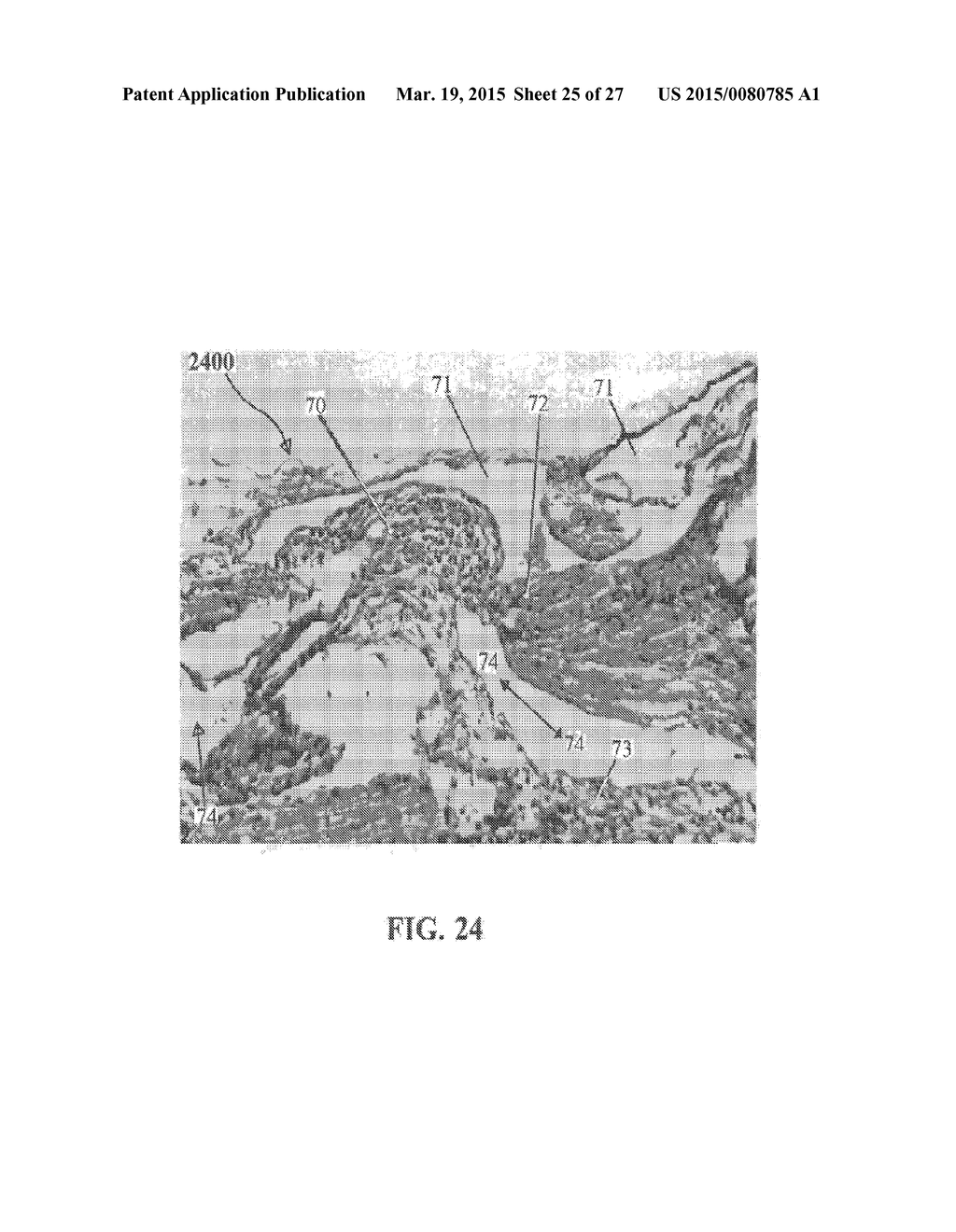 ALZHEIMER'S DISEASE TREATMENT WITH MULTIPLE THERAPEUTIC AGENTS DELIVERED     TO THE OLFACTORY REGION THROUGH A SPECIAL DELIVERY CATHETER AND     IONTOPHORESIS - diagram, schematic, and image 26