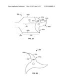 PLEATED OR FOLDED CATHETER-MOUNTED BALLOON diagram and image