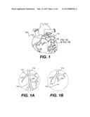 ENDOVASCULAR DEVICES AND METHODS FOR EXPLOITING INTRAMURAL SPACE diagram and image