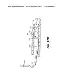 ENDOVASCULAR DEVICES AND METHODS FOR EXPLOITING INTRAMURAL SPACE diagram and image