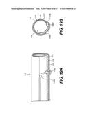 ENDOVASCULAR DEVICES AND METHODS FOR EXPLOITING INTRAMURAL SPACE diagram and image