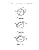 ENDOVASCULAR DEVICES AND METHODS FOR EXPLOITING INTRAMURAL SPACE diagram and image