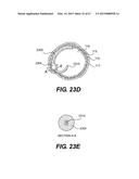 ENDOVASCULAR DEVICES AND METHODS FOR EXPLOITING INTRAMURAL SPACE diagram and image