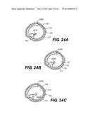 ENDOVASCULAR DEVICES AND METHODS FOR EXPLOITING INTRAMURAL SPACE diagram and image