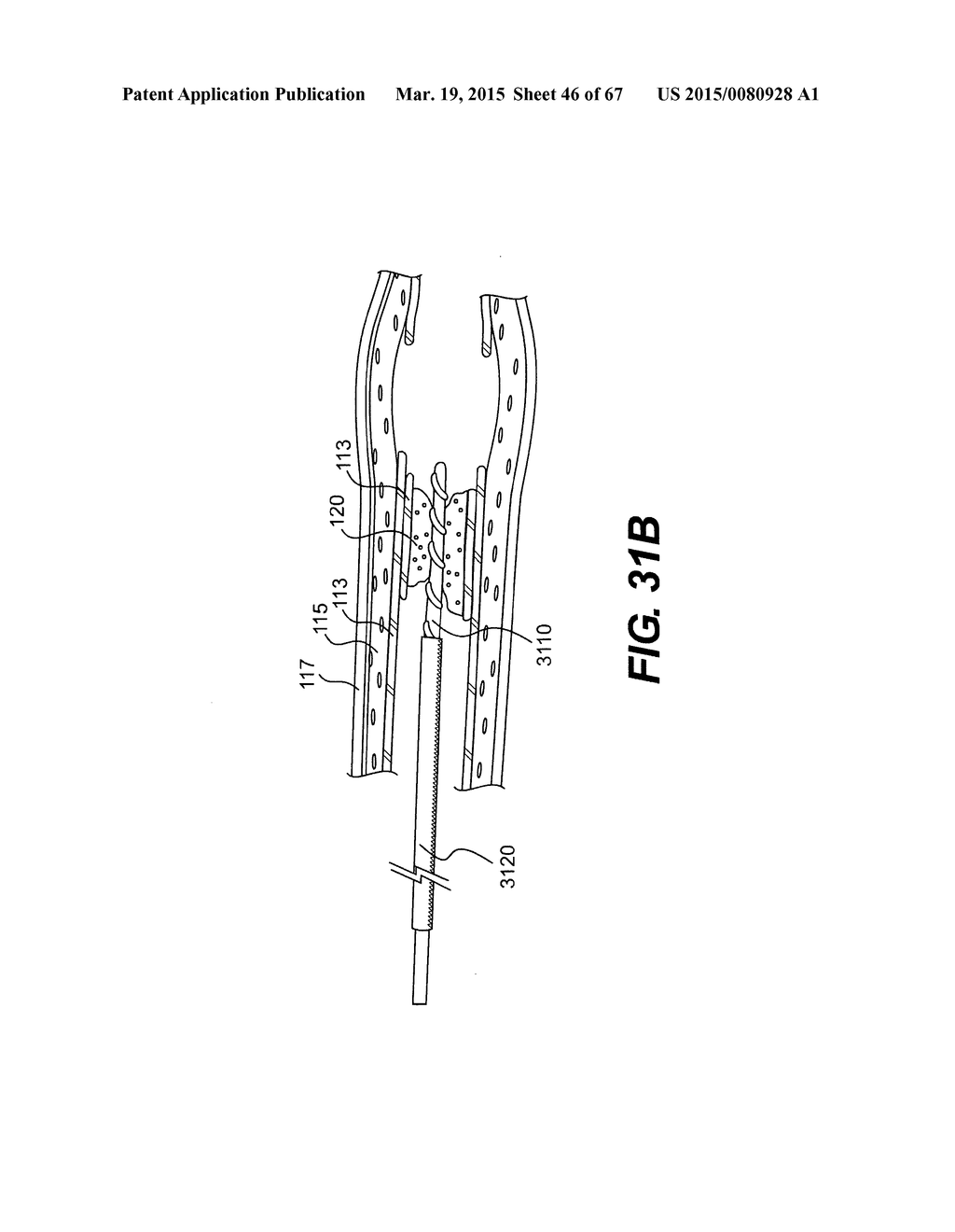 ENDOVASCULAR DEVICES AND METHODS FOR EXPLOITING INTRAMURAL SPACE - diagram, schematic, and image 47