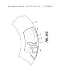 ENDOVASCULAR DEVICES AND METHODS FOR EXPLOITING INTRAMURAL SPACE diagram and image