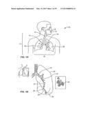 Minimally Invasive Lung Volume Reduction Devices, Methods, and Systems diagram and image