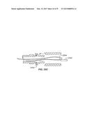 Minimally Invasive Lung Volume Reduction Devices, Methods, and Systems diagram and image