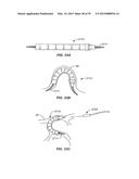 Minimally Invasive Lung Volume Reduction Devices, Methods, and Systems diagram and image