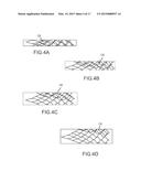 ENDOVASCULAR DEVICE ENGAGEMENT diagram and image